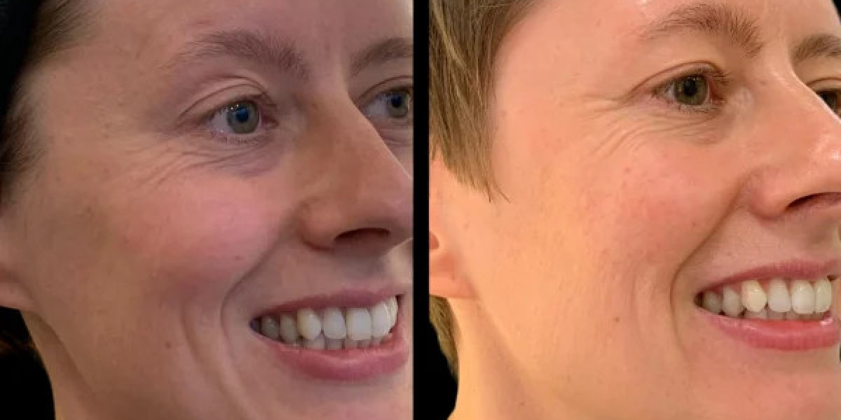 Best Plastic Surgeon in Dubai for Structured Profhilo Care Plans